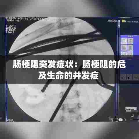 肠梗阻突发症状:肠梗阻的危及生命的并发症