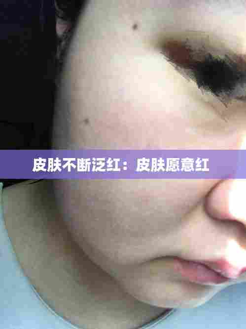 皮肤不断泛红:皮肤愿意红