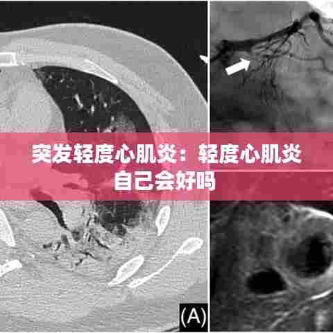 突发轻度心肌炎:轻度心肌炎自己会好吗