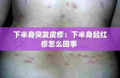 下半身突发皮疹:下半身起红疹怎么回事