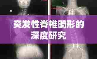 突发性脊椎畸形的深度研究