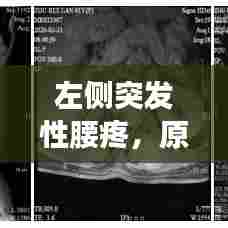 左侧突发性腰疼,原因、症状及治疗方法详解