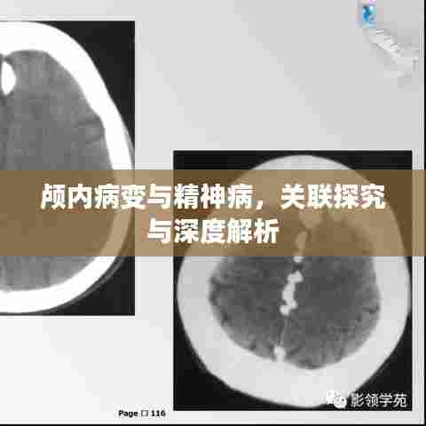 颅内病变与精神病,关联探究与深度解析